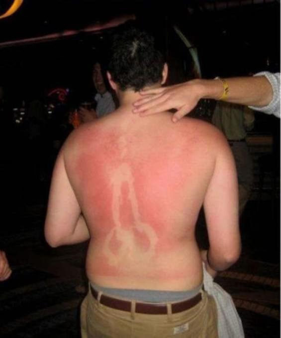 sunburns-16.jpg