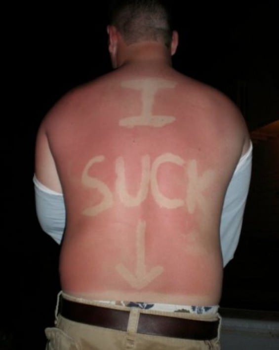 sunburns-18.jpg